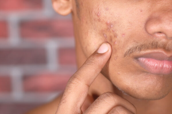 Acne pode causar complicações sérias à pele, para além da questão estética