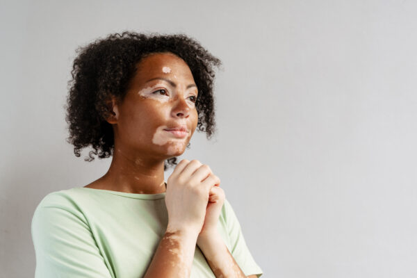 Dia Mundial do Vitiligo chama atenção para mais informações sobre a doença